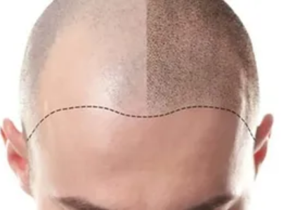 Scalp Micropigmentation