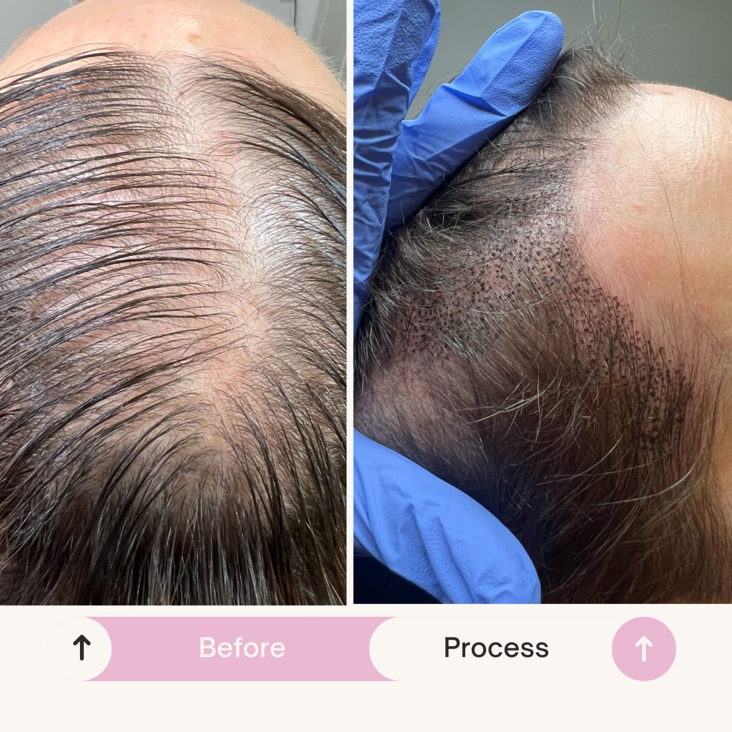 Scalp Micropigmentation